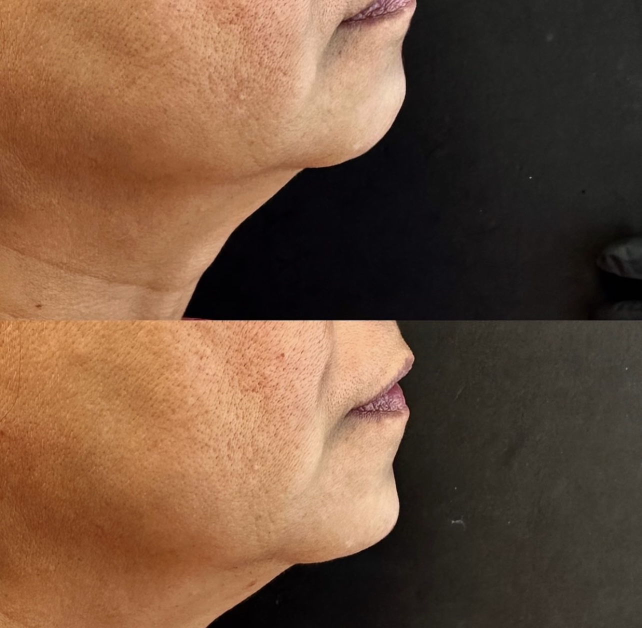 chin-augmentation Patient 3