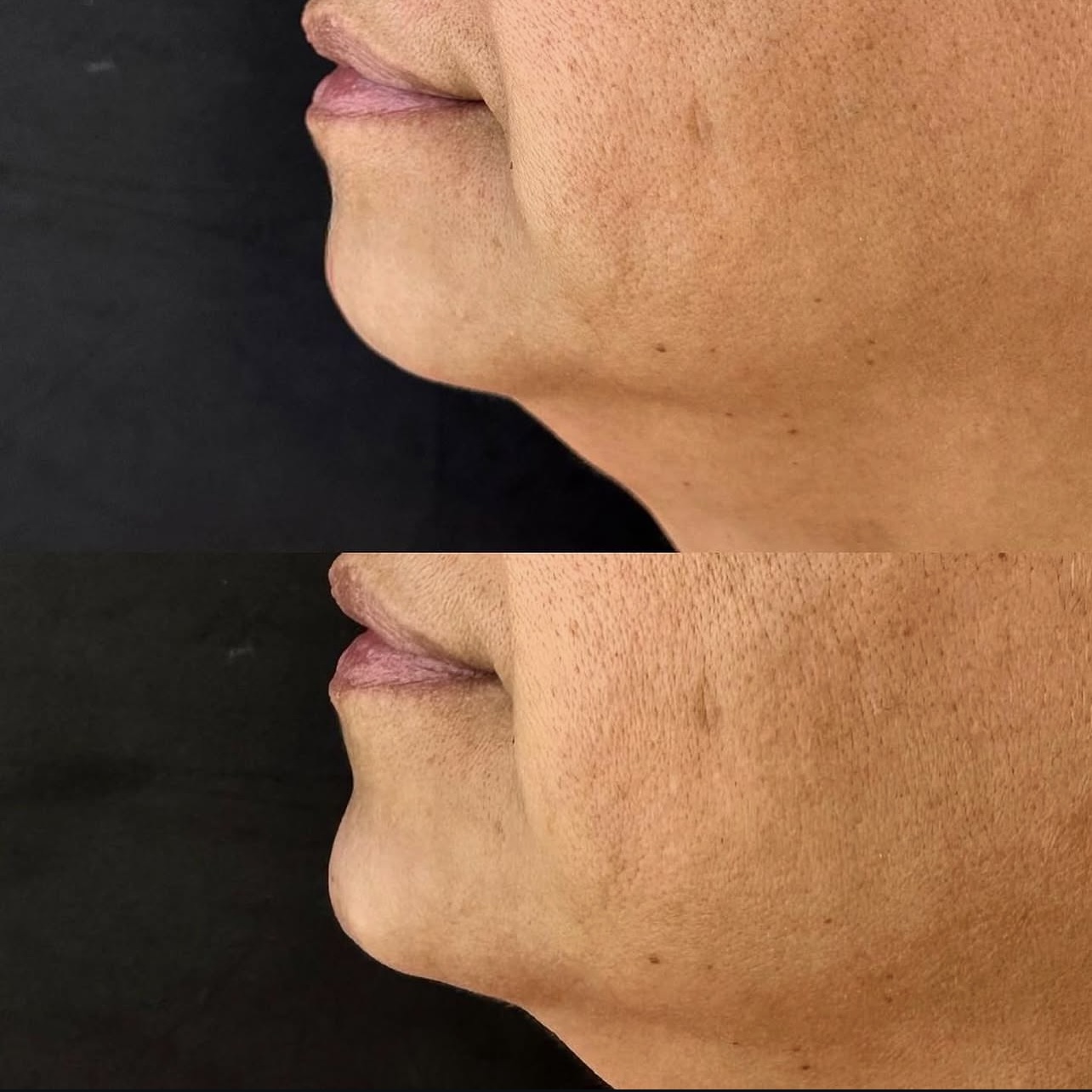 chin-augmentation Patient 2