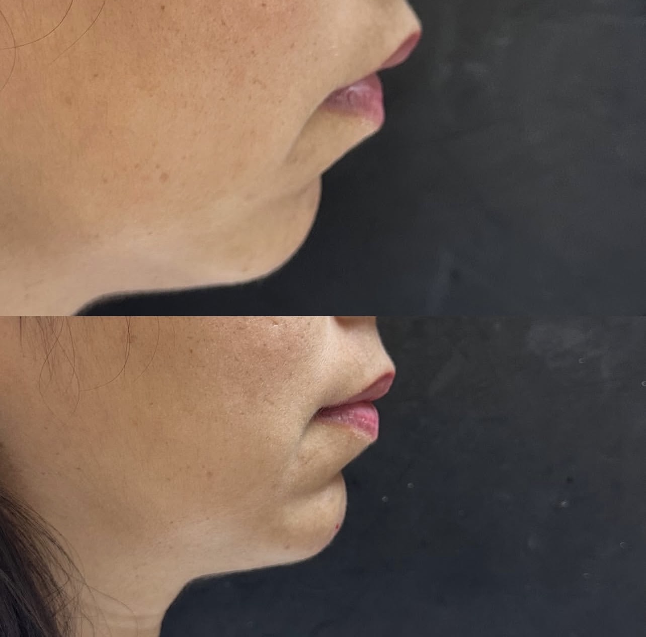 chin-augmentation Patient 1