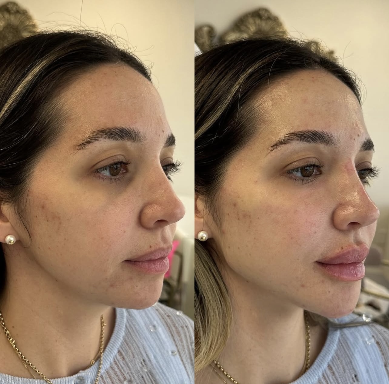 facial-harmonization Patient 3