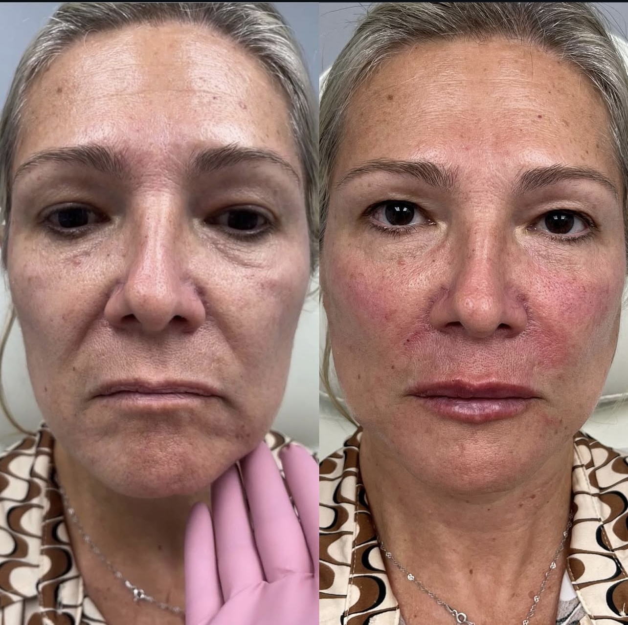 facial-harmonization Patient 2