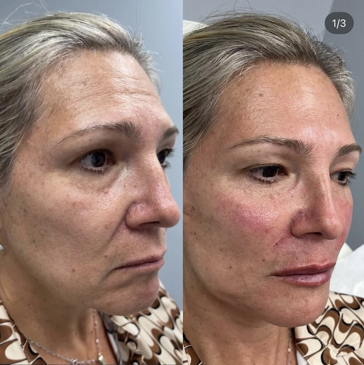 facial-harmonization Patient 1