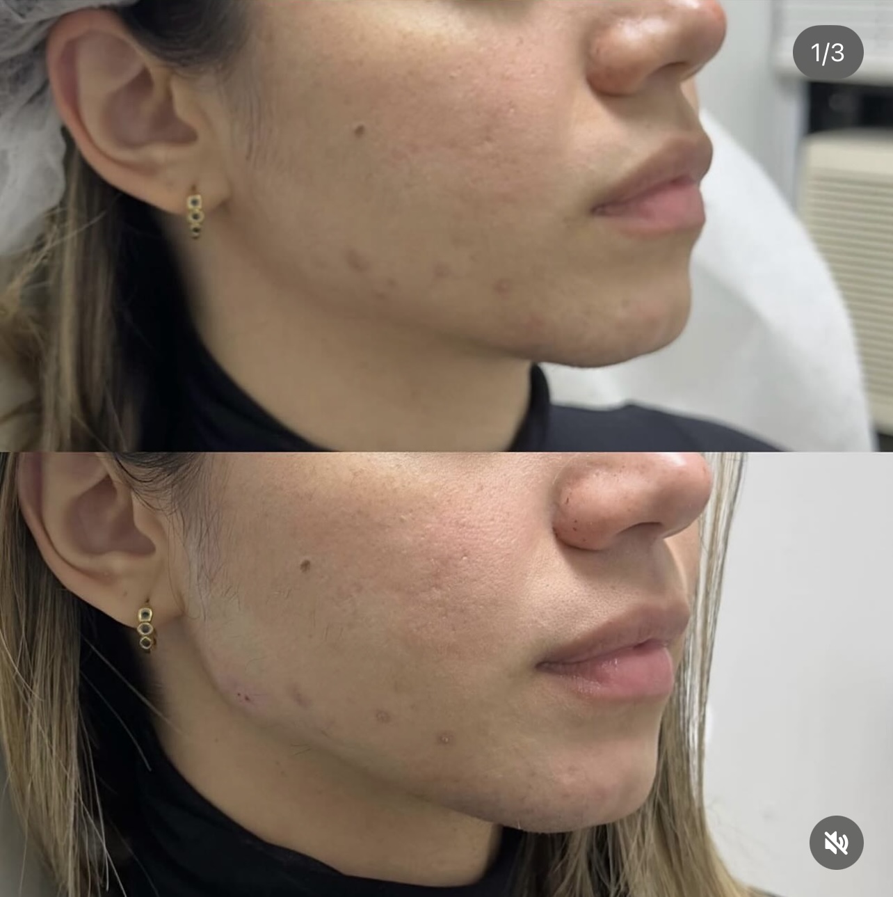 jawline Patient 4