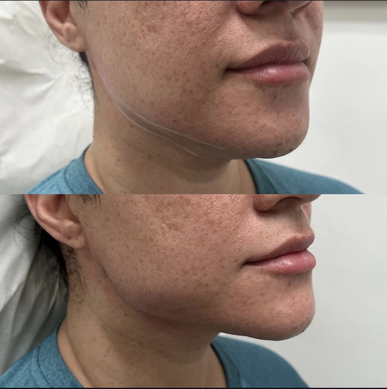 jawline Patient 3