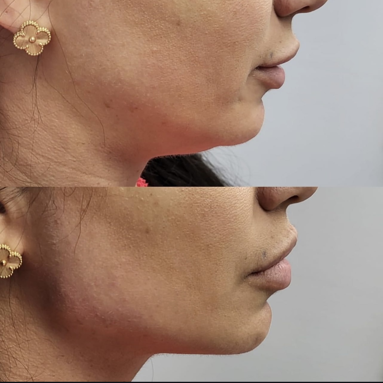 jawline Patient 2