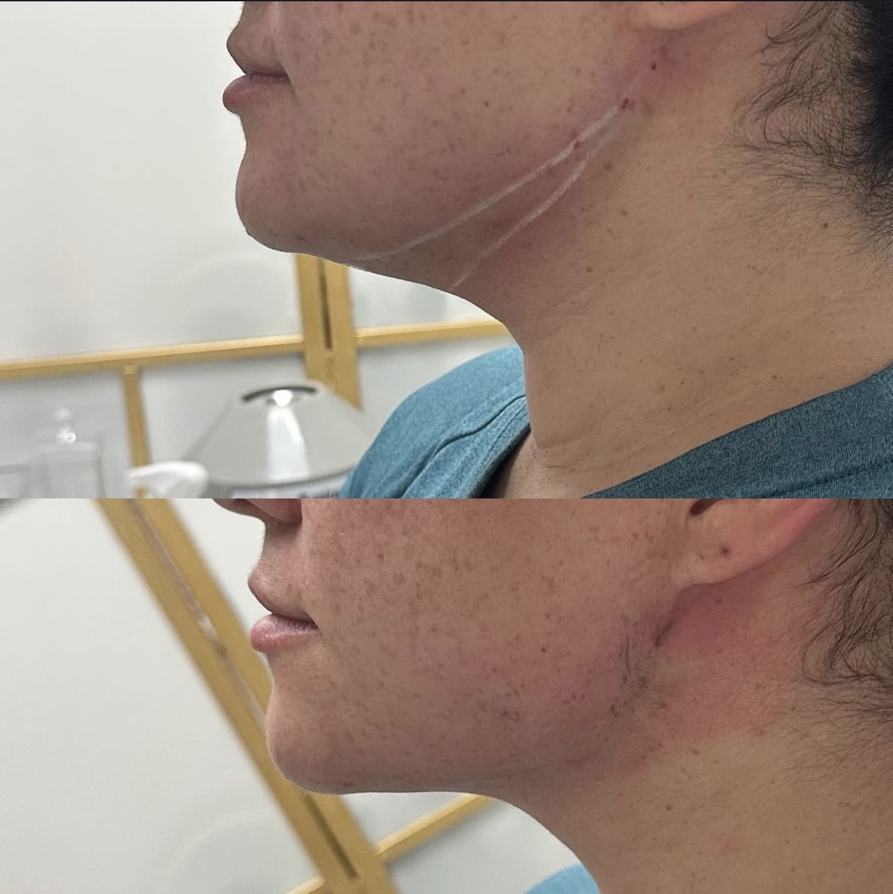 Patient 2 real result for kybella