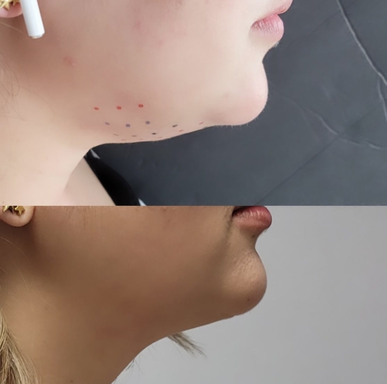 Patient 1 real result for kybella