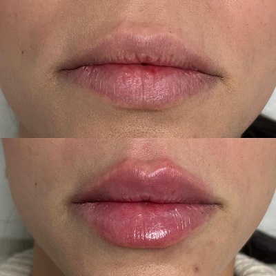 Patient 24 real result for lip augmentation