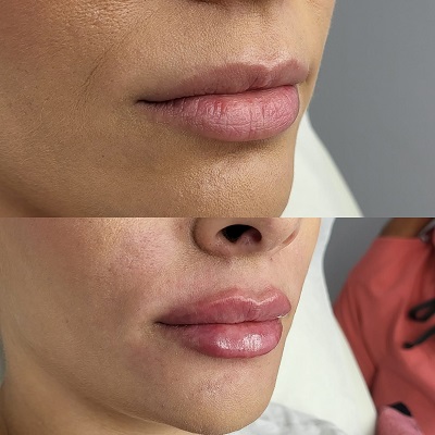 Patient 23 real result for lip augmentation