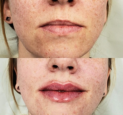 Patient 22 real result for lip augmentation