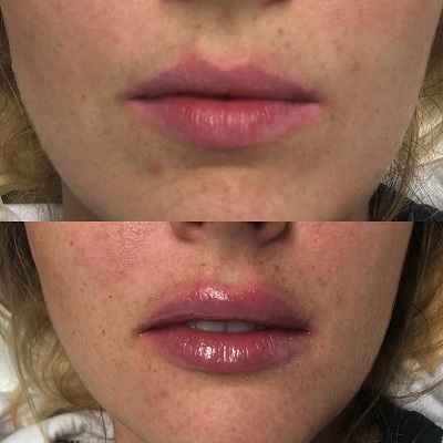 Patient 21 real result for lip augmentation