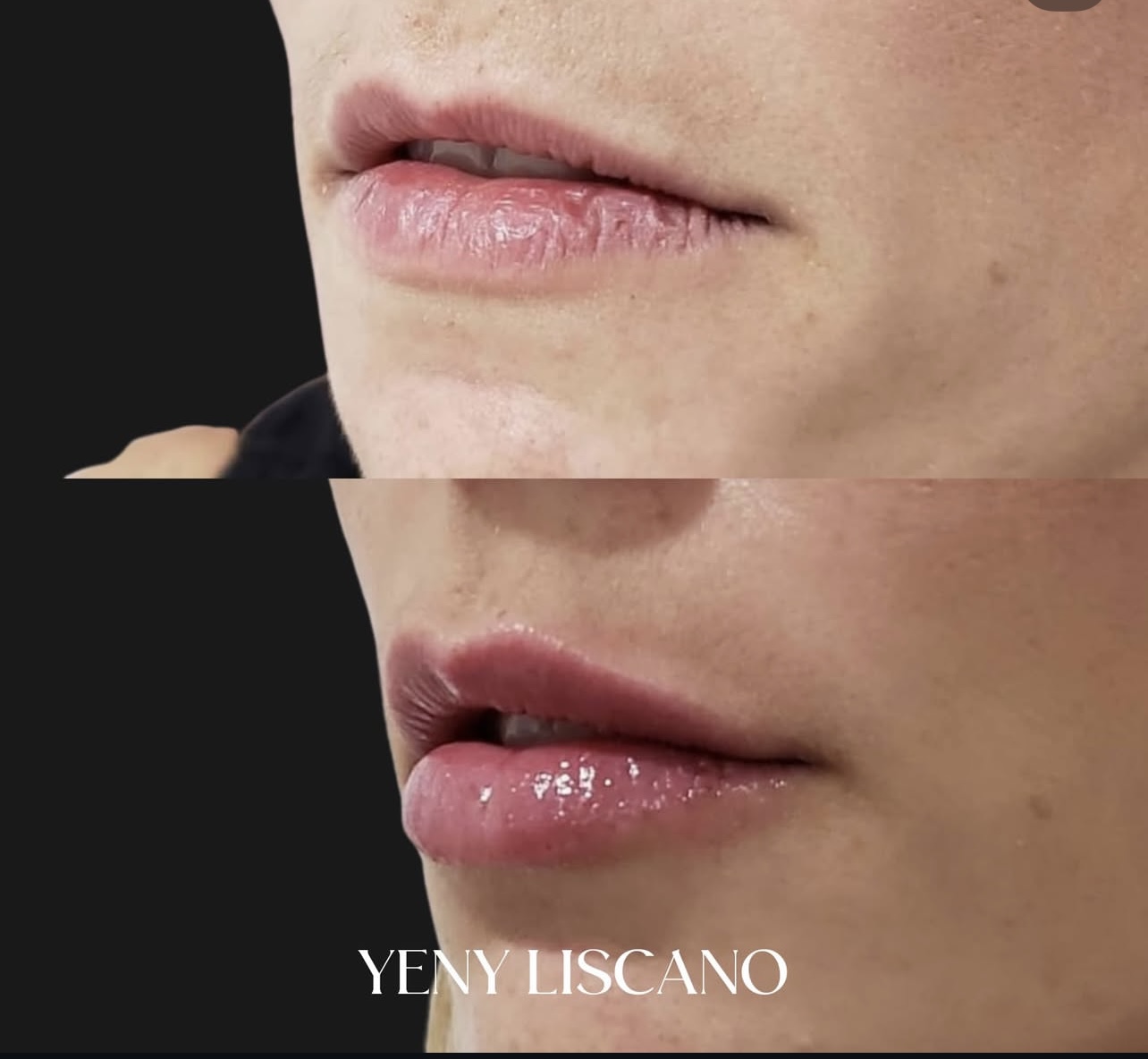 Patient 20 real result for lip augmentation