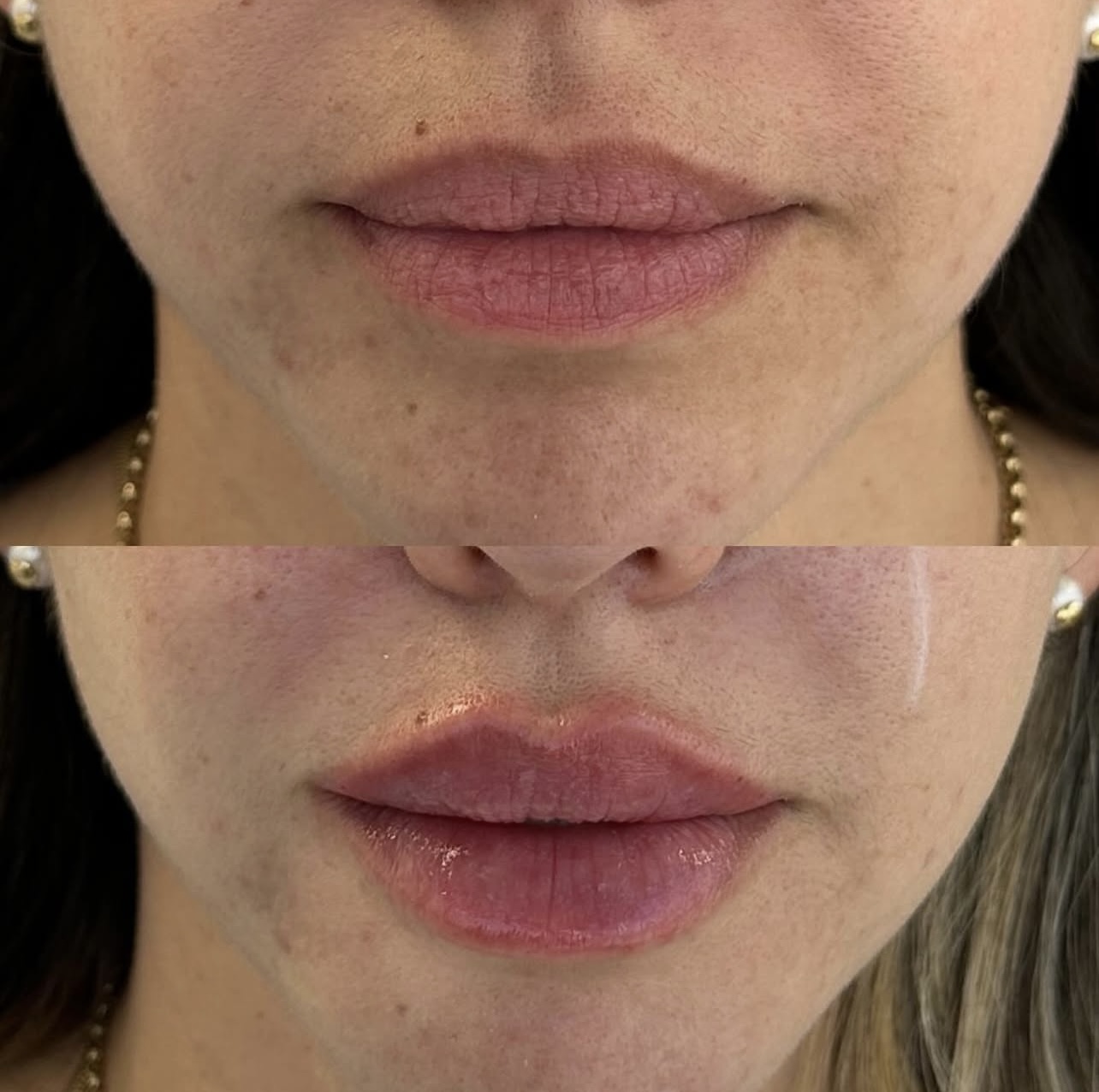 Patient 19 real result for lip augmentation