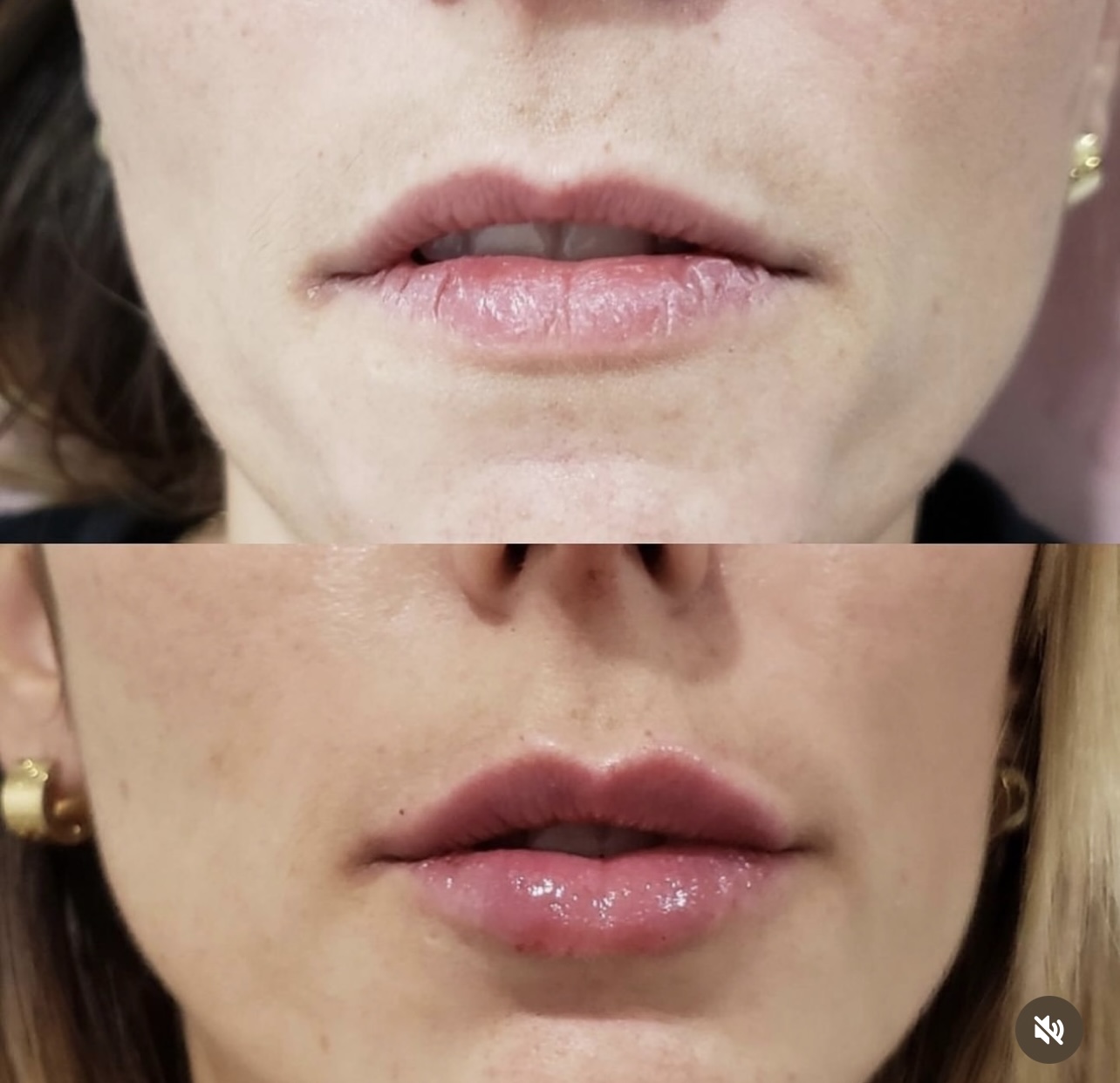 Patient 18 real result for lip augmentation
