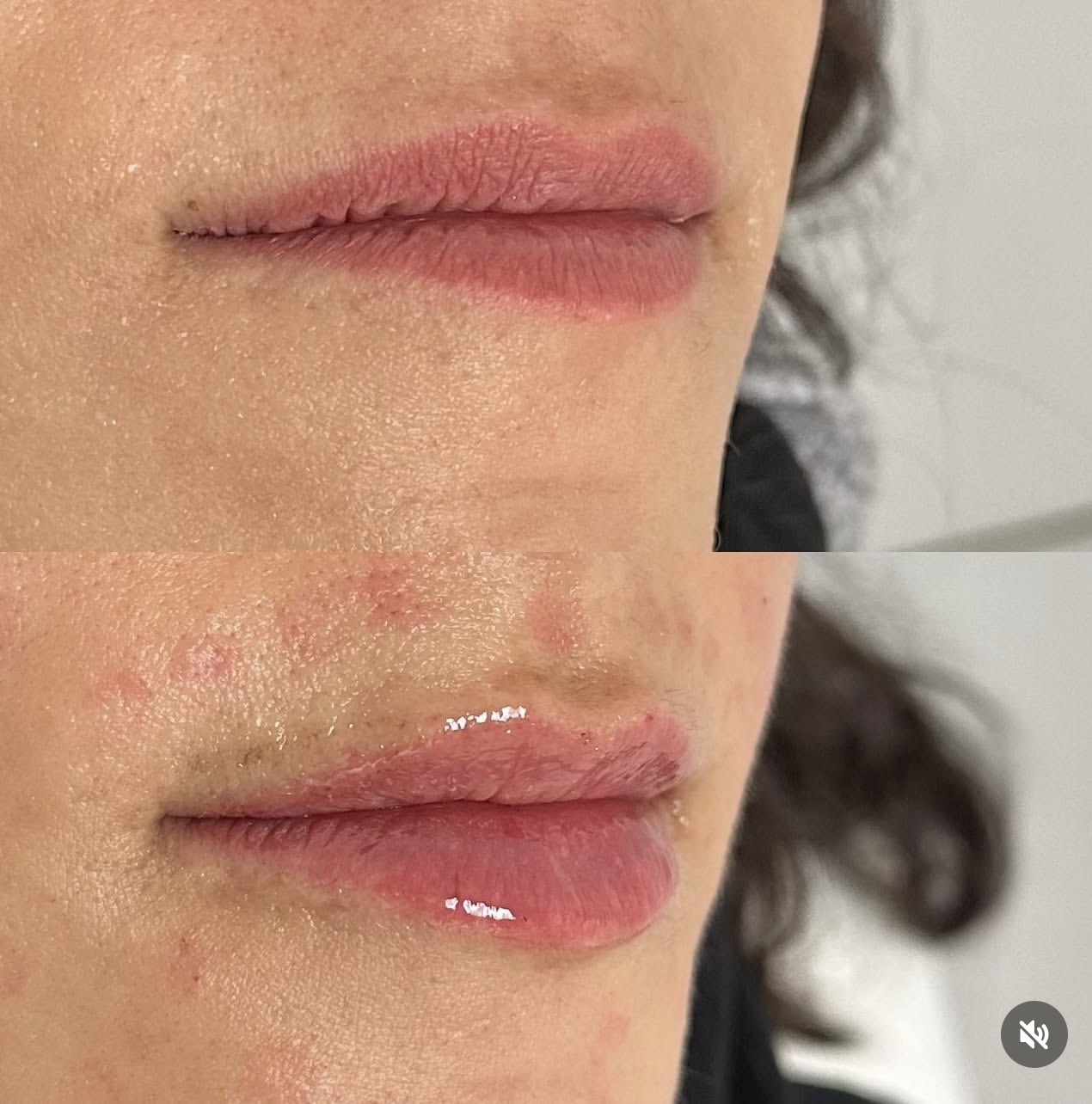 Patient 17 real result for lip augmentation