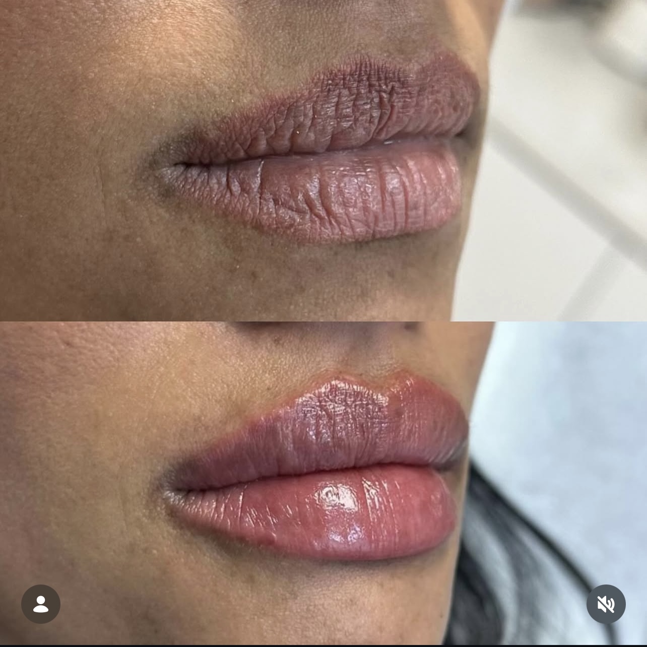 Patient 16 real result for lip augmentation