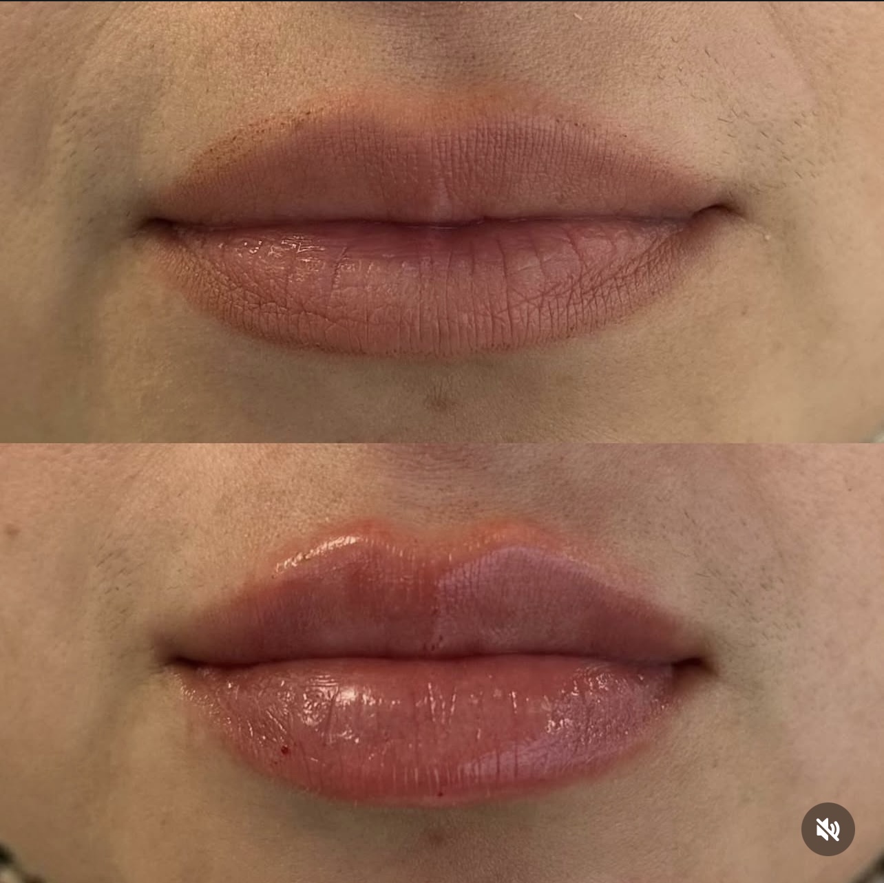 Patient 15 real result for lip augmentation