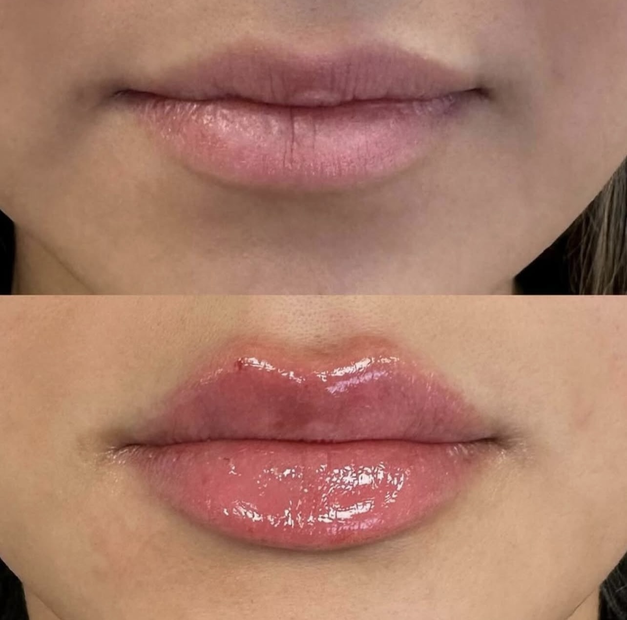 Patient 14 real result for lip augmentation