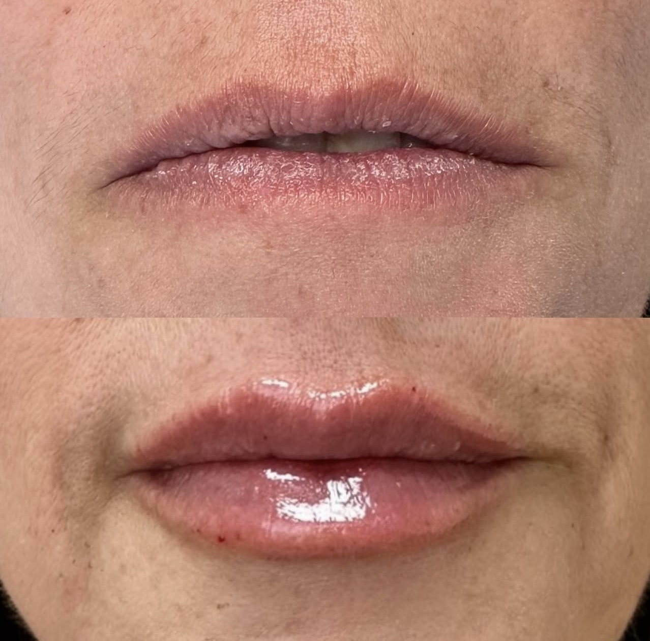 Patient 13 real result for lip augmentation
