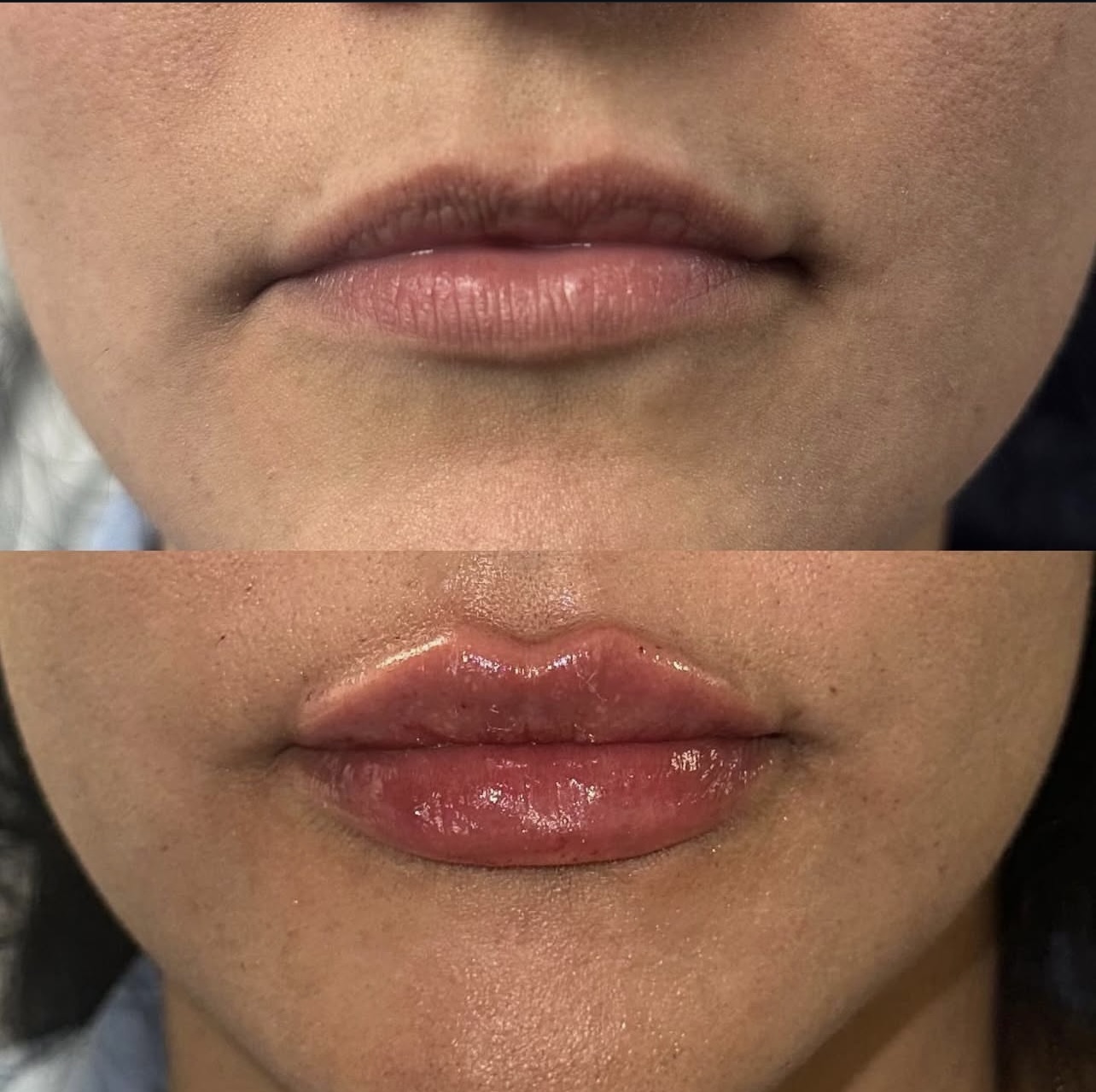 Patient 12 real result for lip augmentation