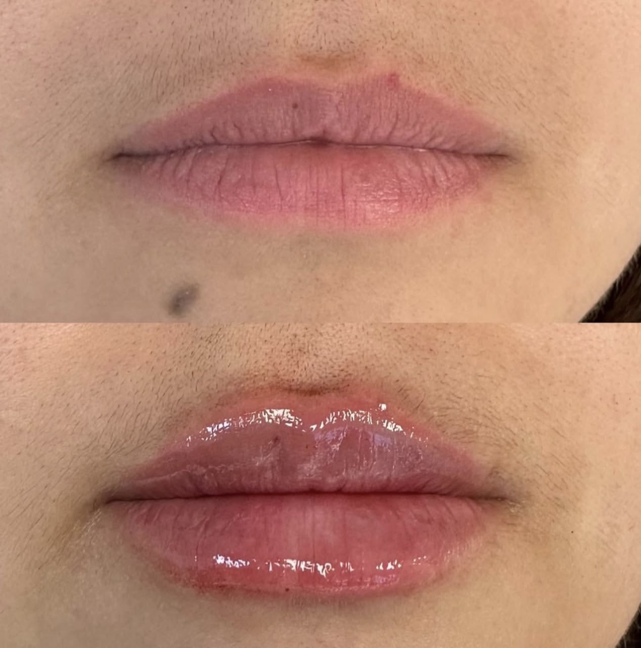 Patient 11 real result for lip augmentation