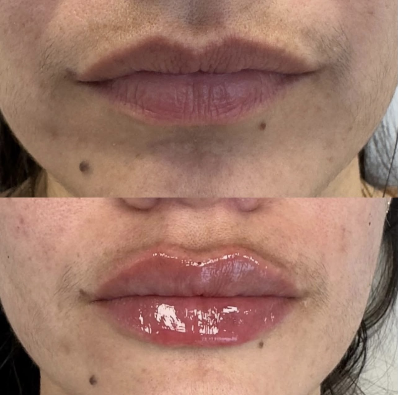 Patient 10 real result for lip augmentation