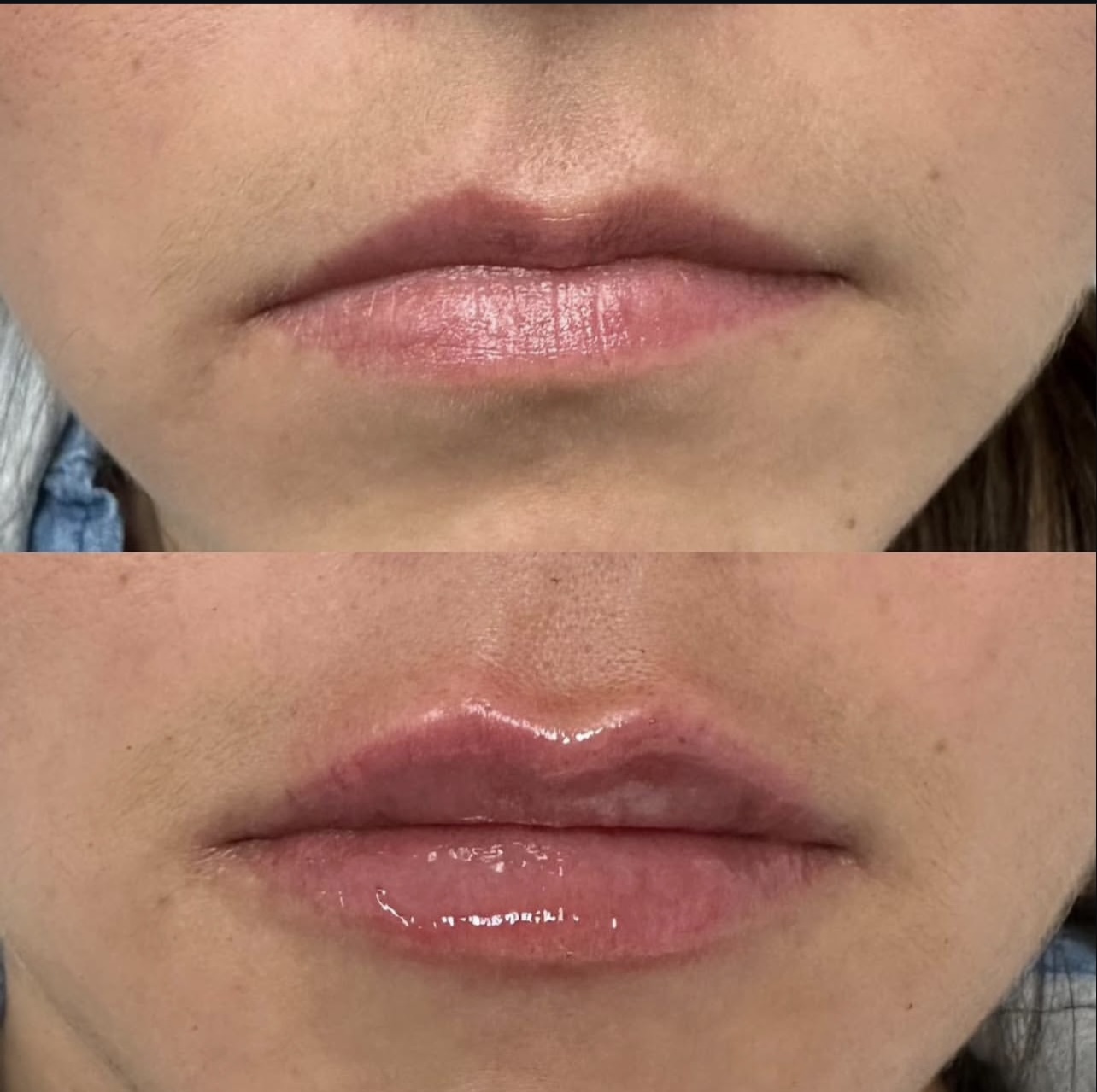 Patient 9 real result for lip augmentation
