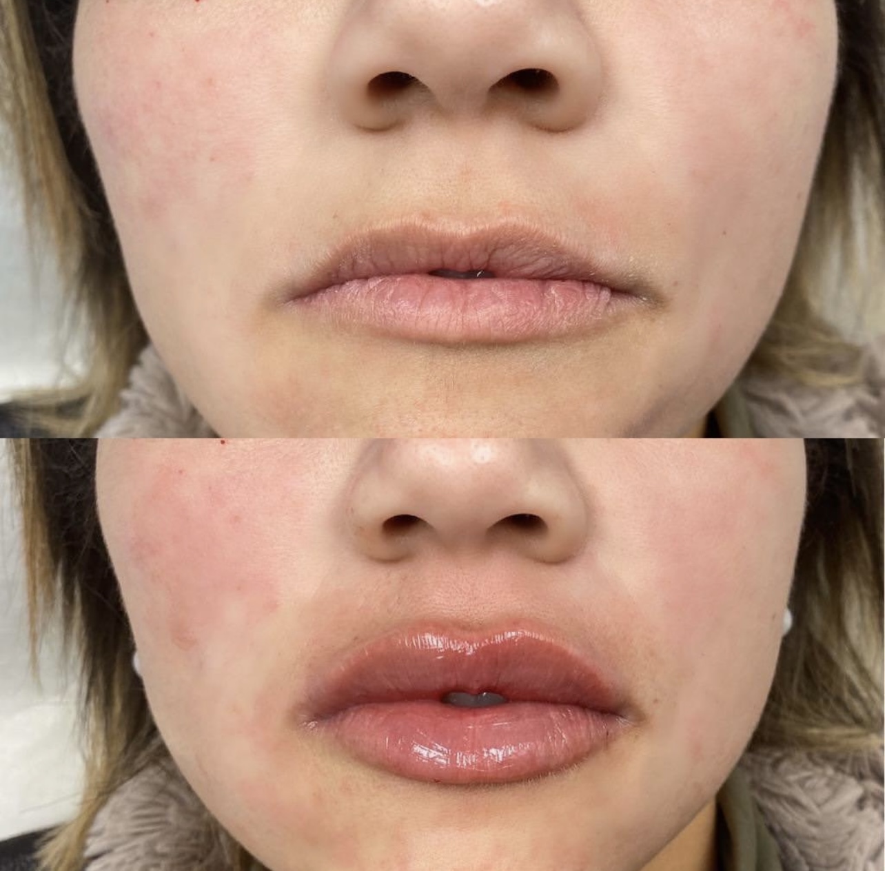 Patient 8 real result for lip augmentation