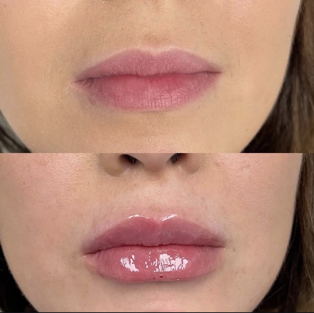 Patient 7 real result for lip augmentation