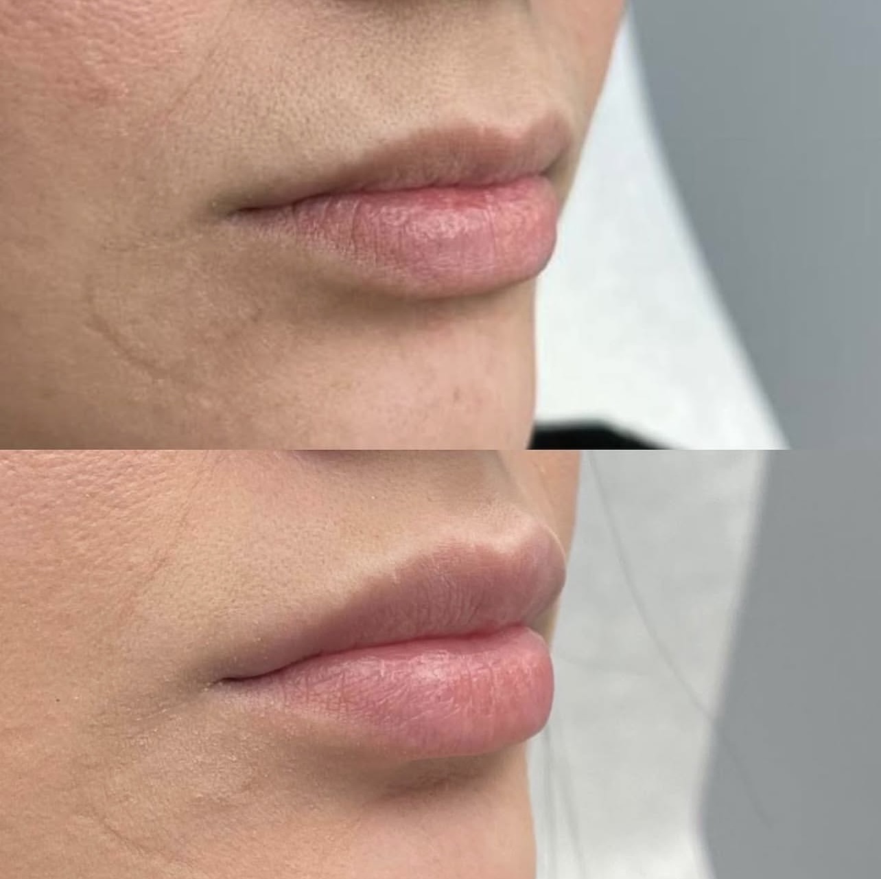 Patient 6 real result for lip augmentation