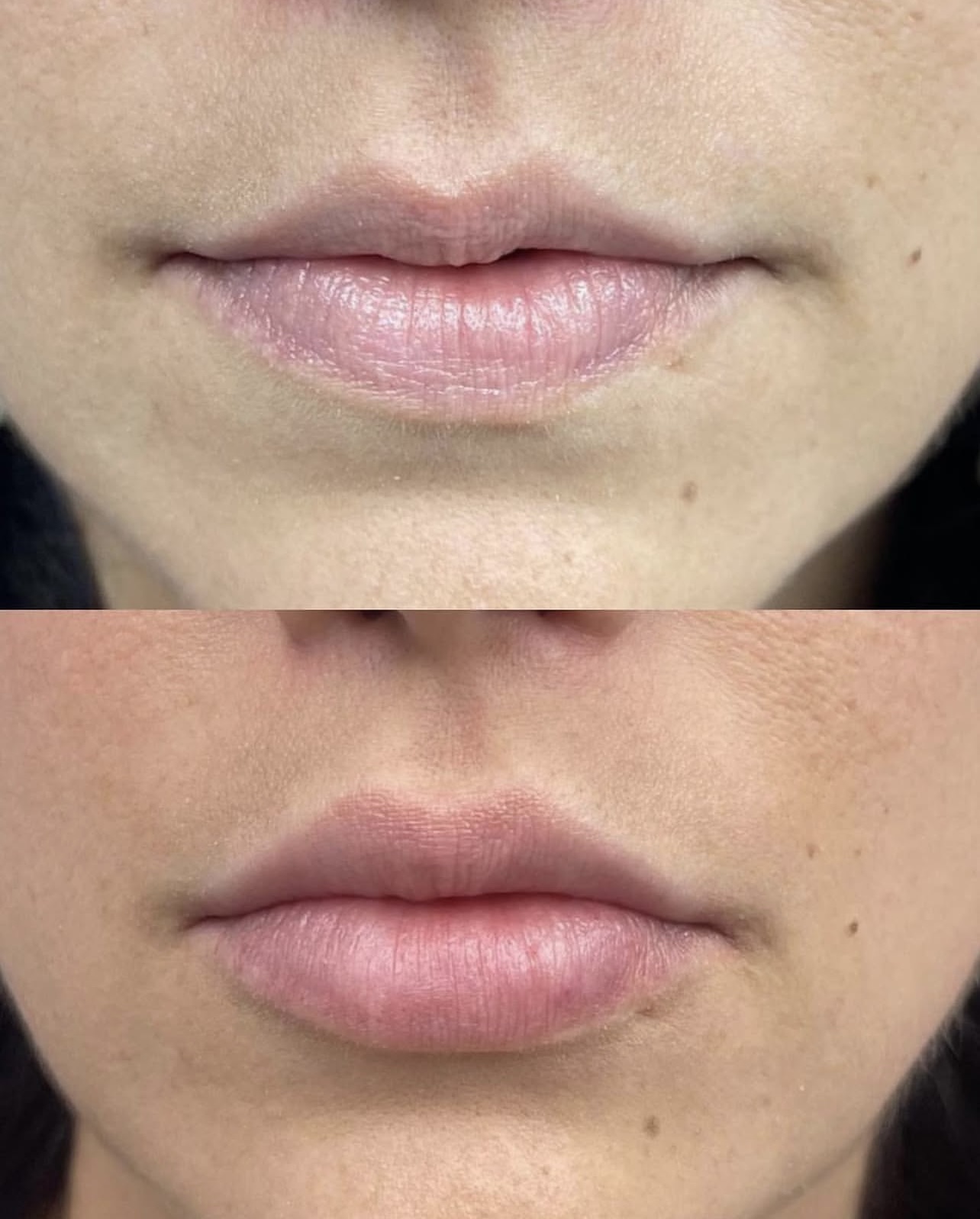 Patient 5 real result for lip augmentation