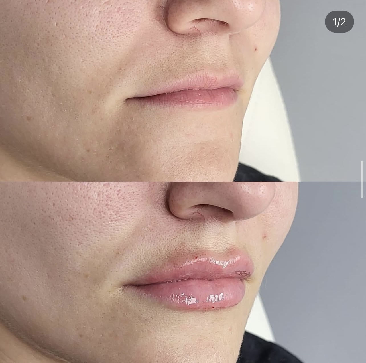 Patient 4 real result for lip augmentation