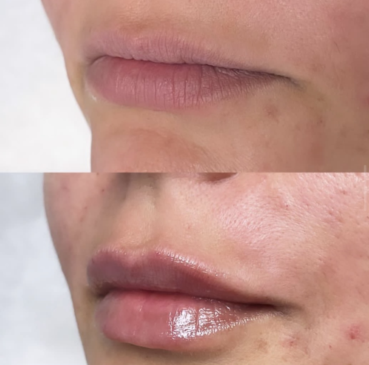 Patient 3 real result for lip augmentation