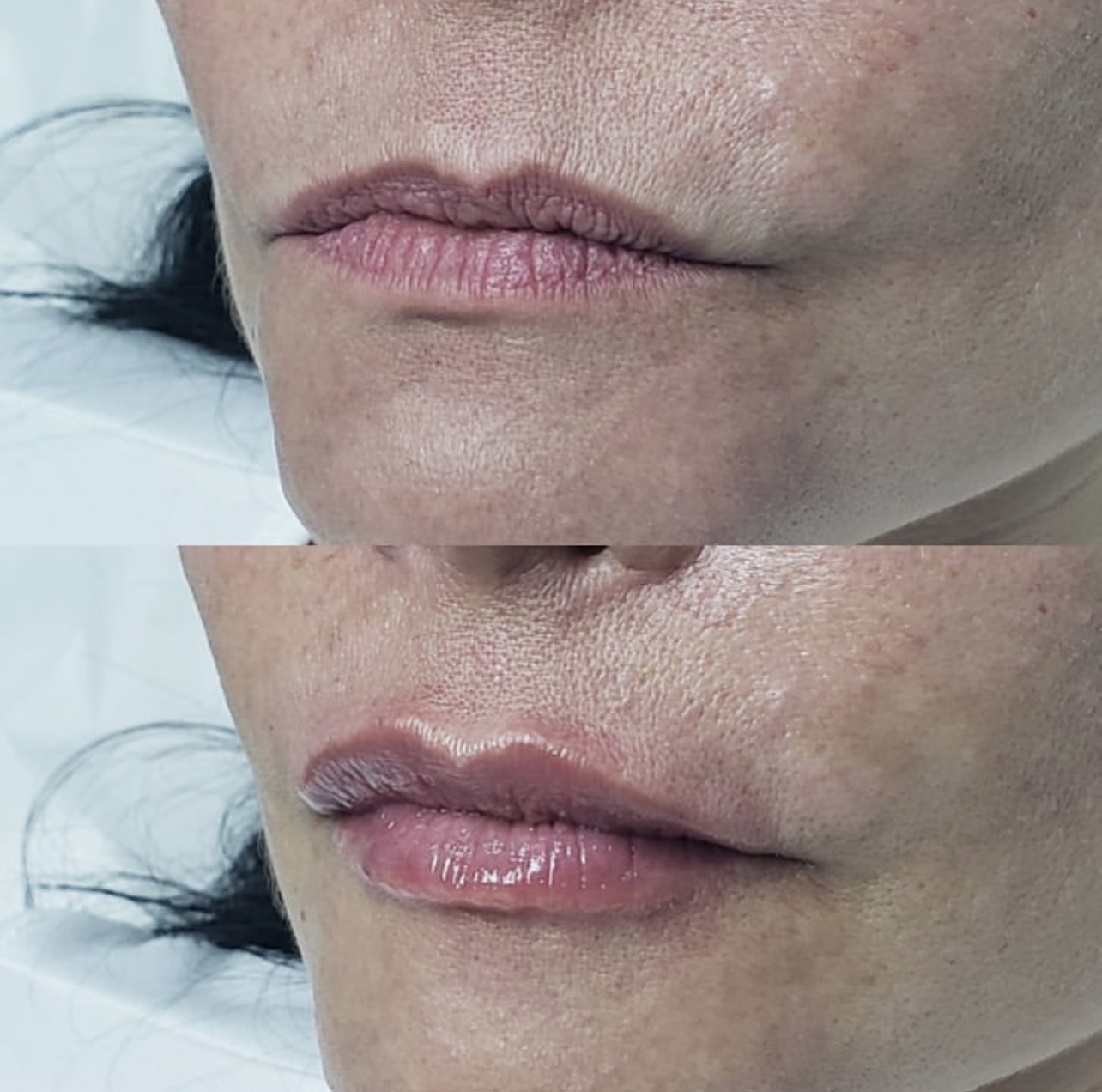 Patient 2 real result for lip augmentation