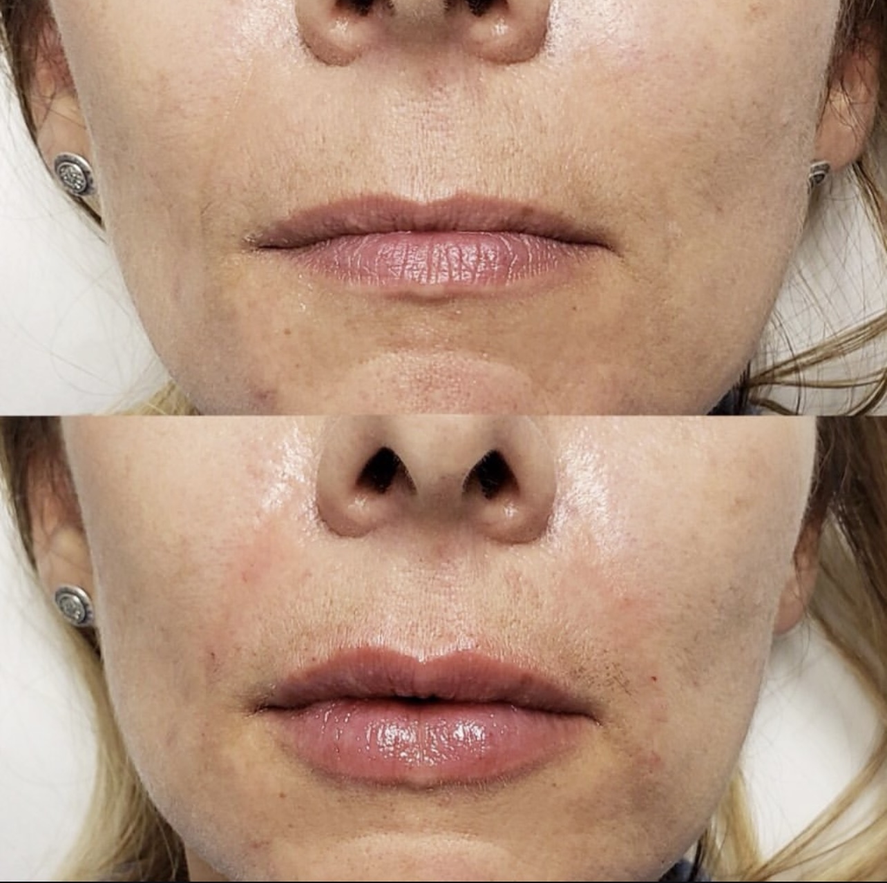 Patient 1 real result for lip augmentation