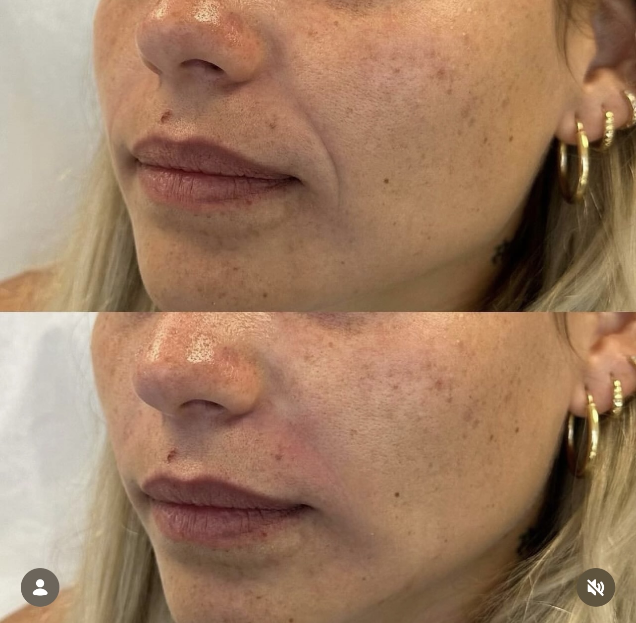 Patient 2 real result for nasolabial fold correction