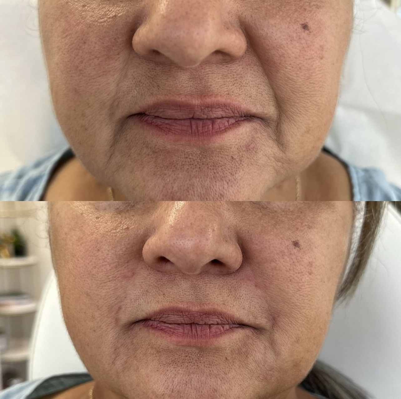 Patient 1 real result for nasolabial fold correction