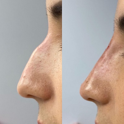 Patient 21 real result for rhinoplasty