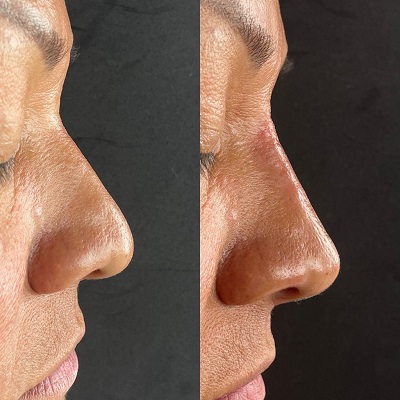 Patient 20 real result for rhinoplasty