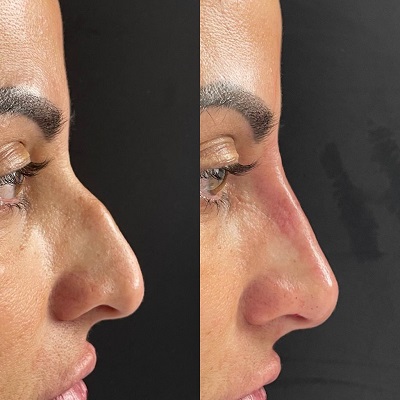 Patient 19 real result for rhinoplasty