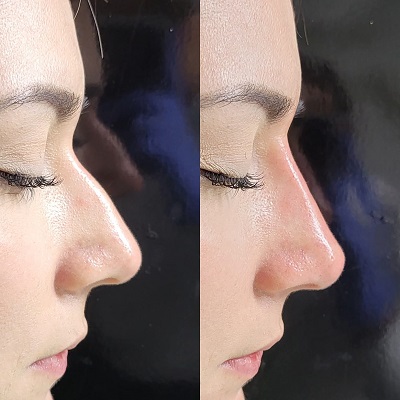 Patient 18 real result for rhinoplasty