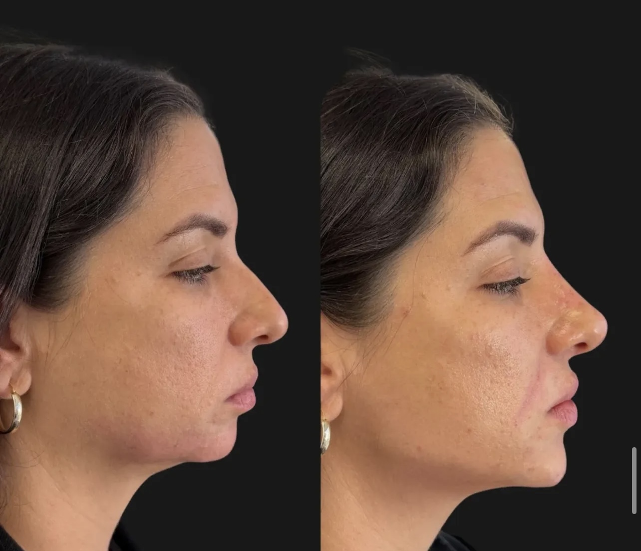 Patient 17 real result for rhinoplasty