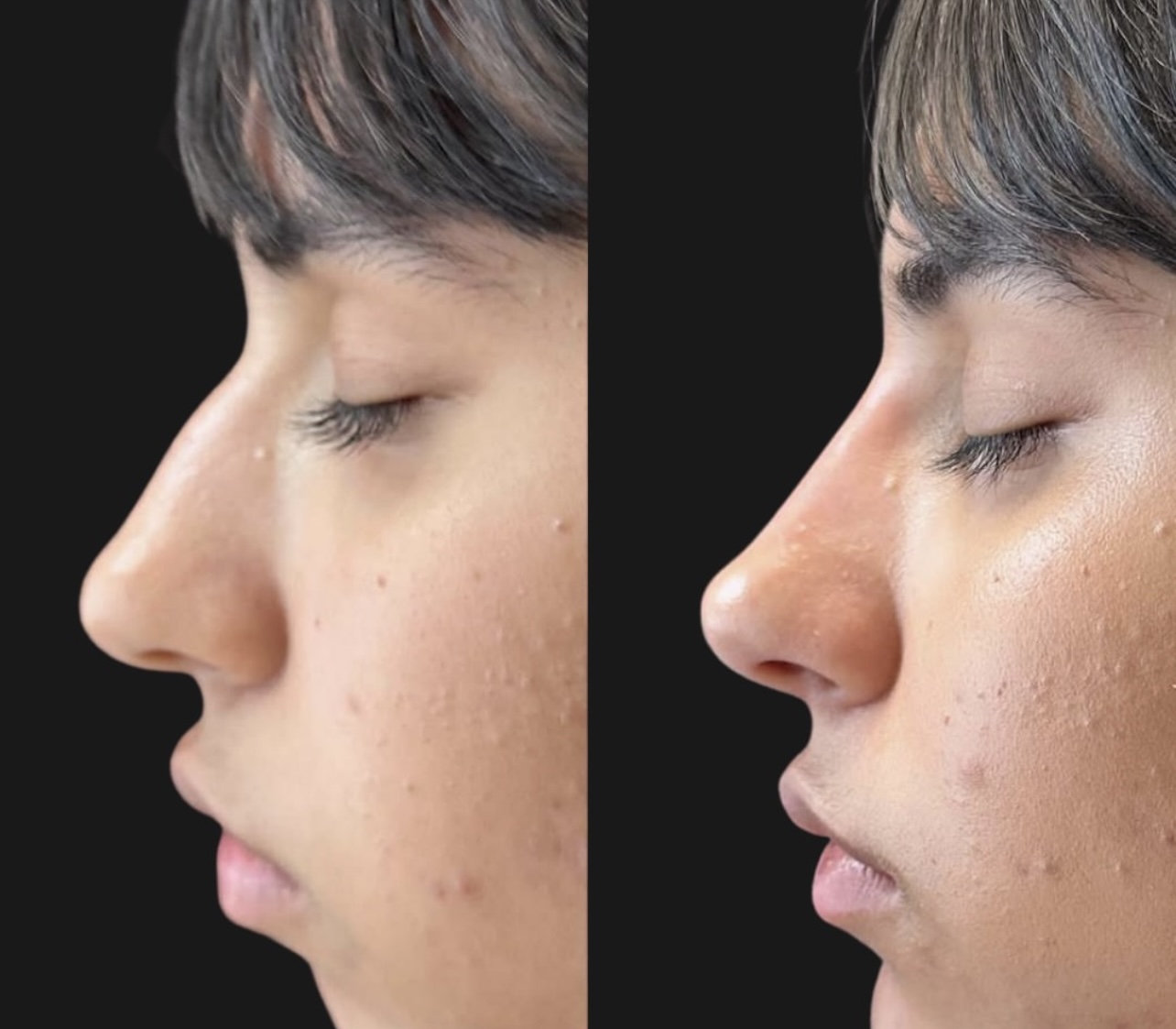 Patient 16 real result for rhinoplasty