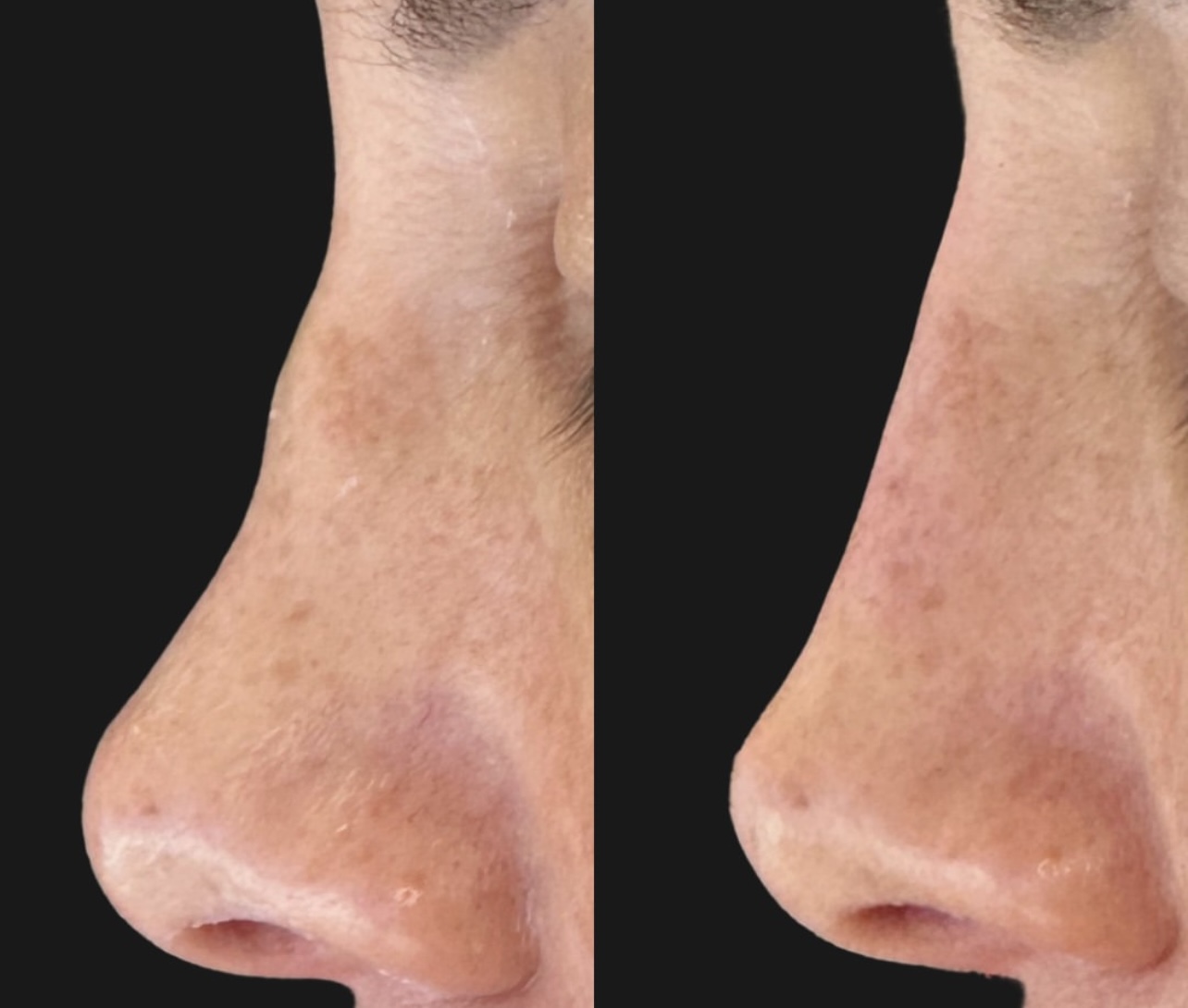 Patient 15 real result for rhinoplasty