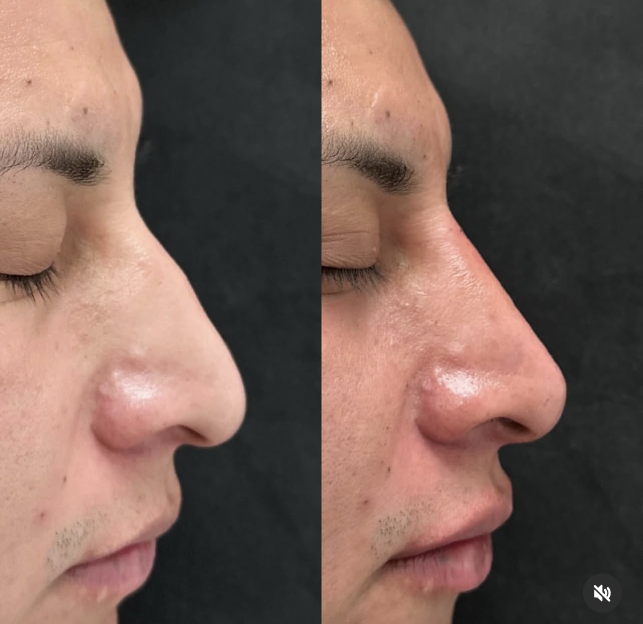 Patient 14 real result for rhinoplasty
