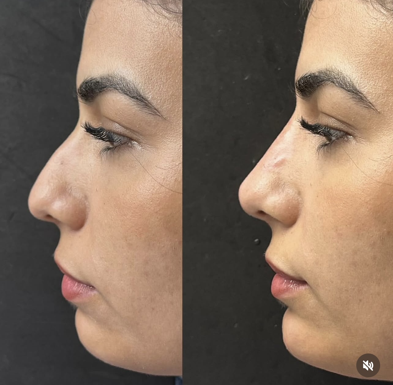 Patient 13 real result for rhinoplasty