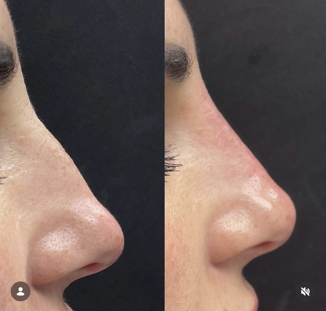 Patient 12 real result for rhinoplasty