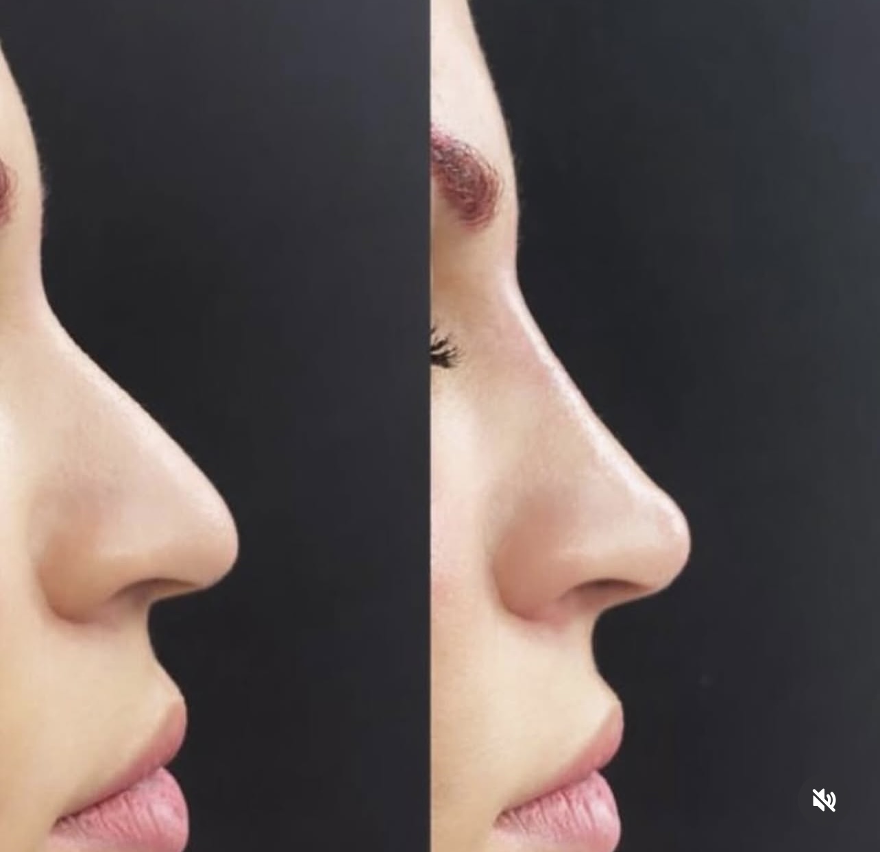 Patient 11 real result for rhinoplasty