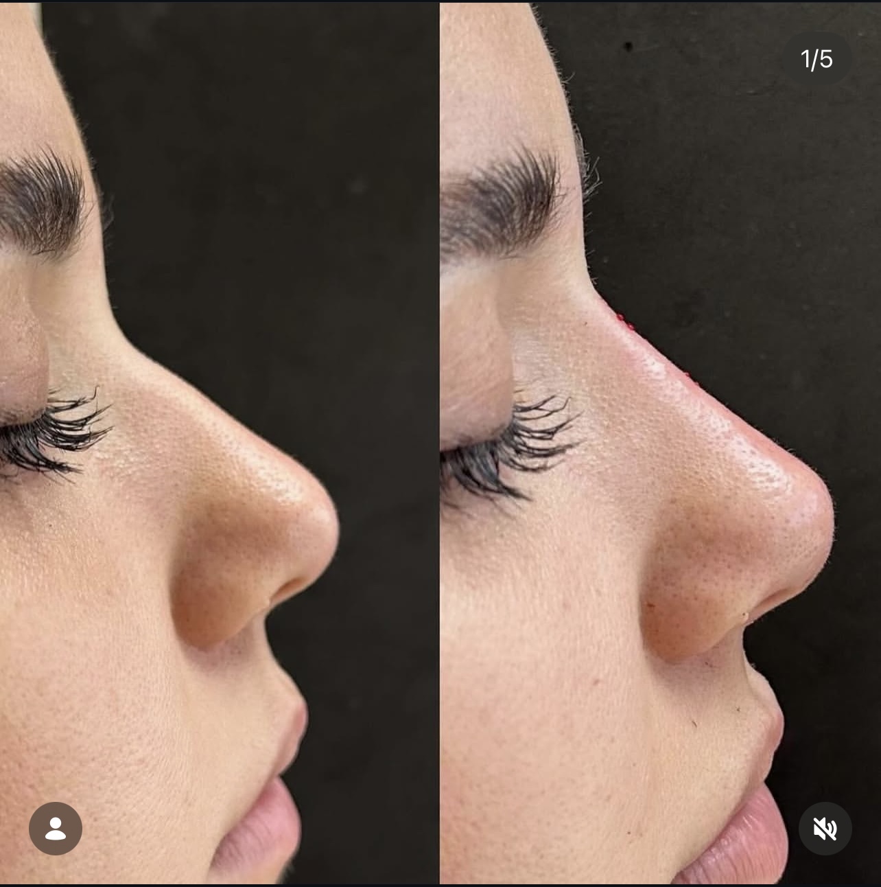 Patient 10 real result for rhinoplasty