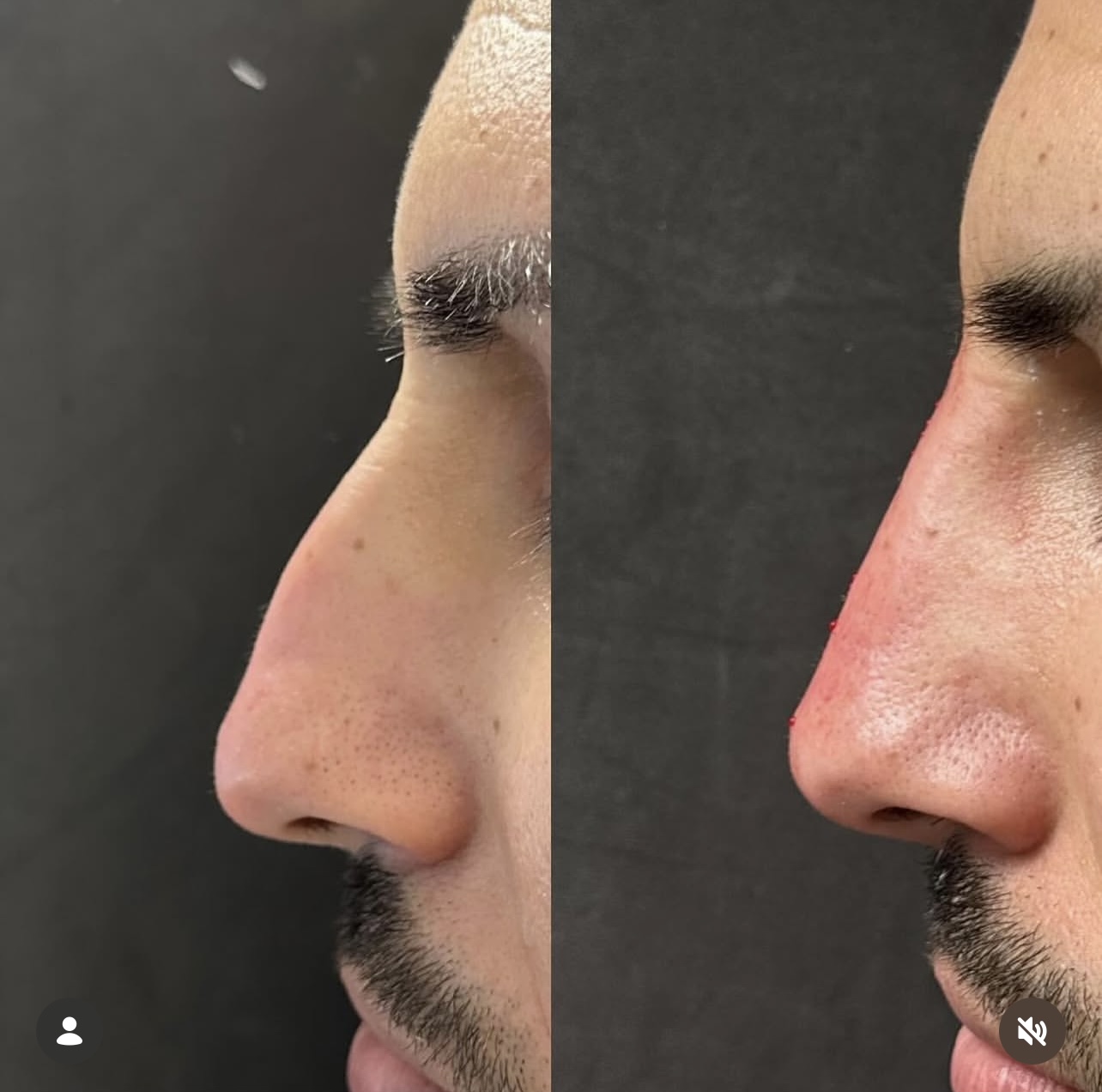 Patient 9 real result for rhinoplasty